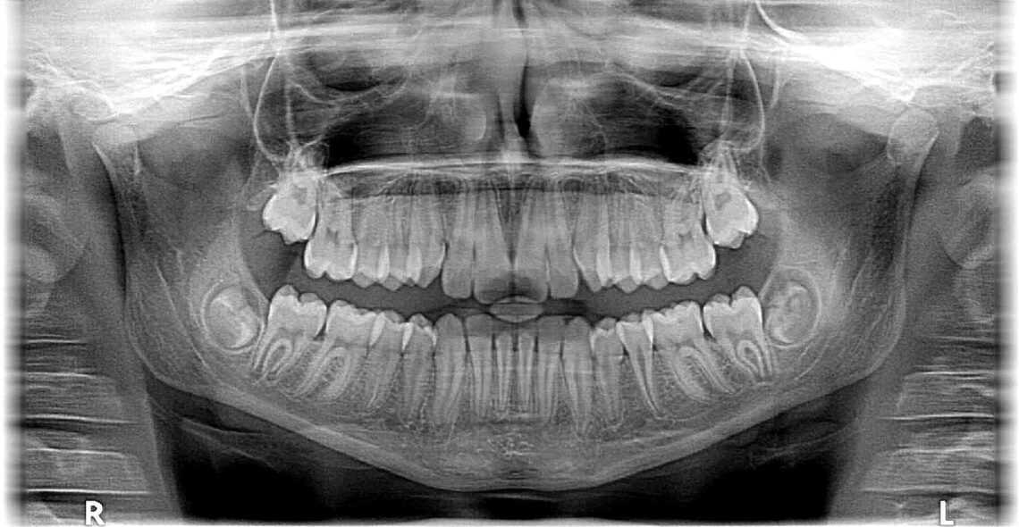 Zdjęcie panoramiczne zębów - kiedy należy je wykonać?